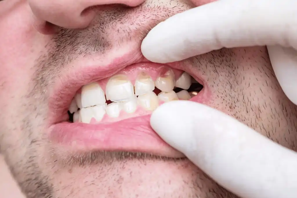does teeth whitening weaken the teeth Cannock